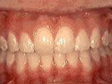 overbite-after
